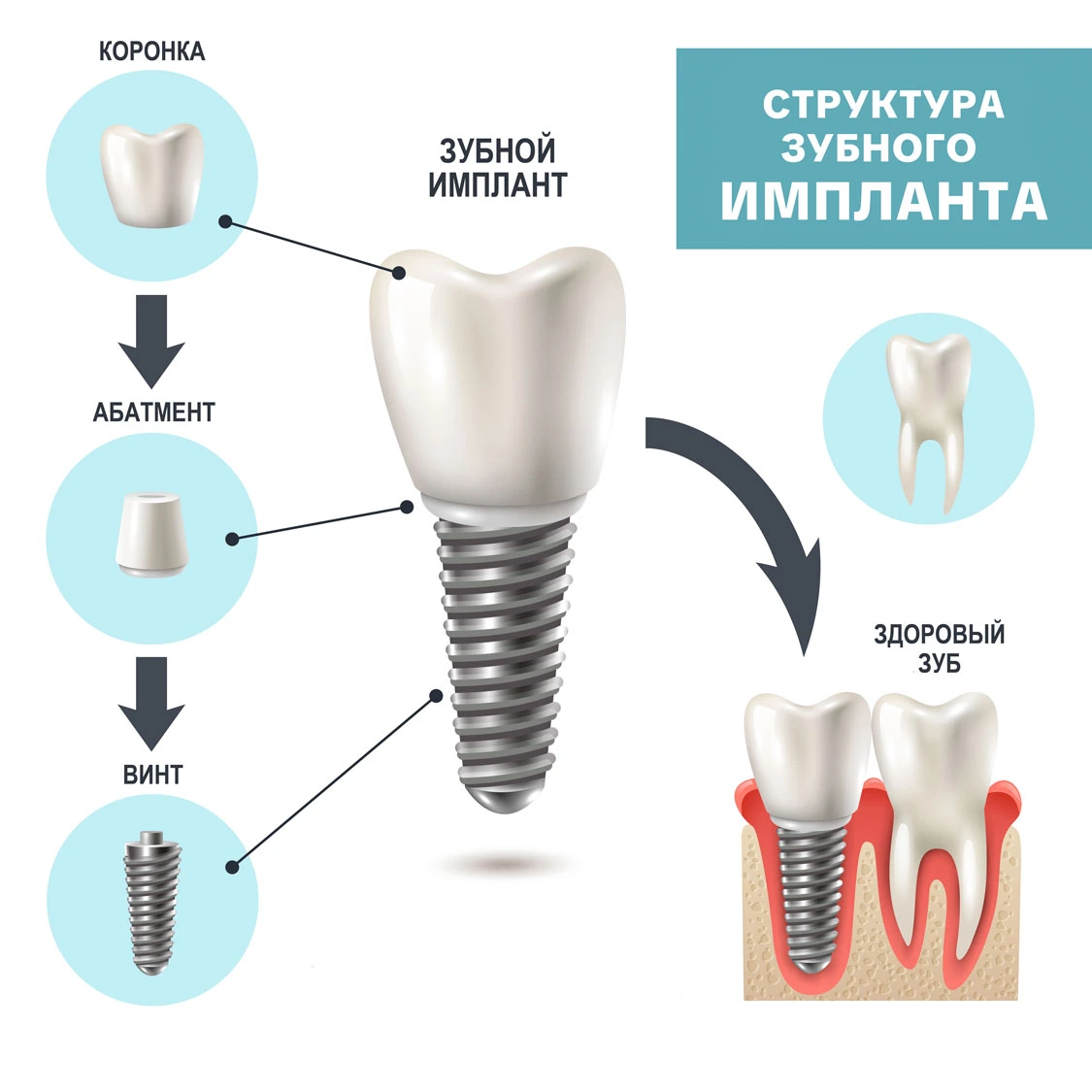 Импланты